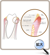 歯周病