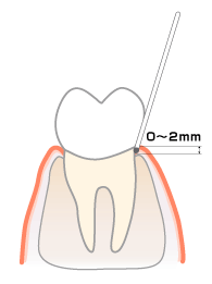 歯周ポケット診査