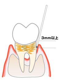 歯周ポケット診査