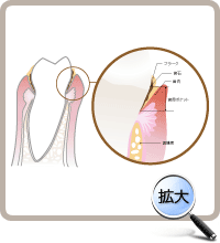 細菌性沈着物（プラーク、歯石）の悪影響