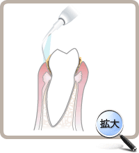 浅い部位の歯石除去