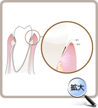 歯肉の浅い部位のスケーリング後