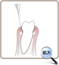 歯周ポケット内のルートプレーニング