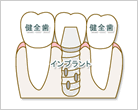 インプラント